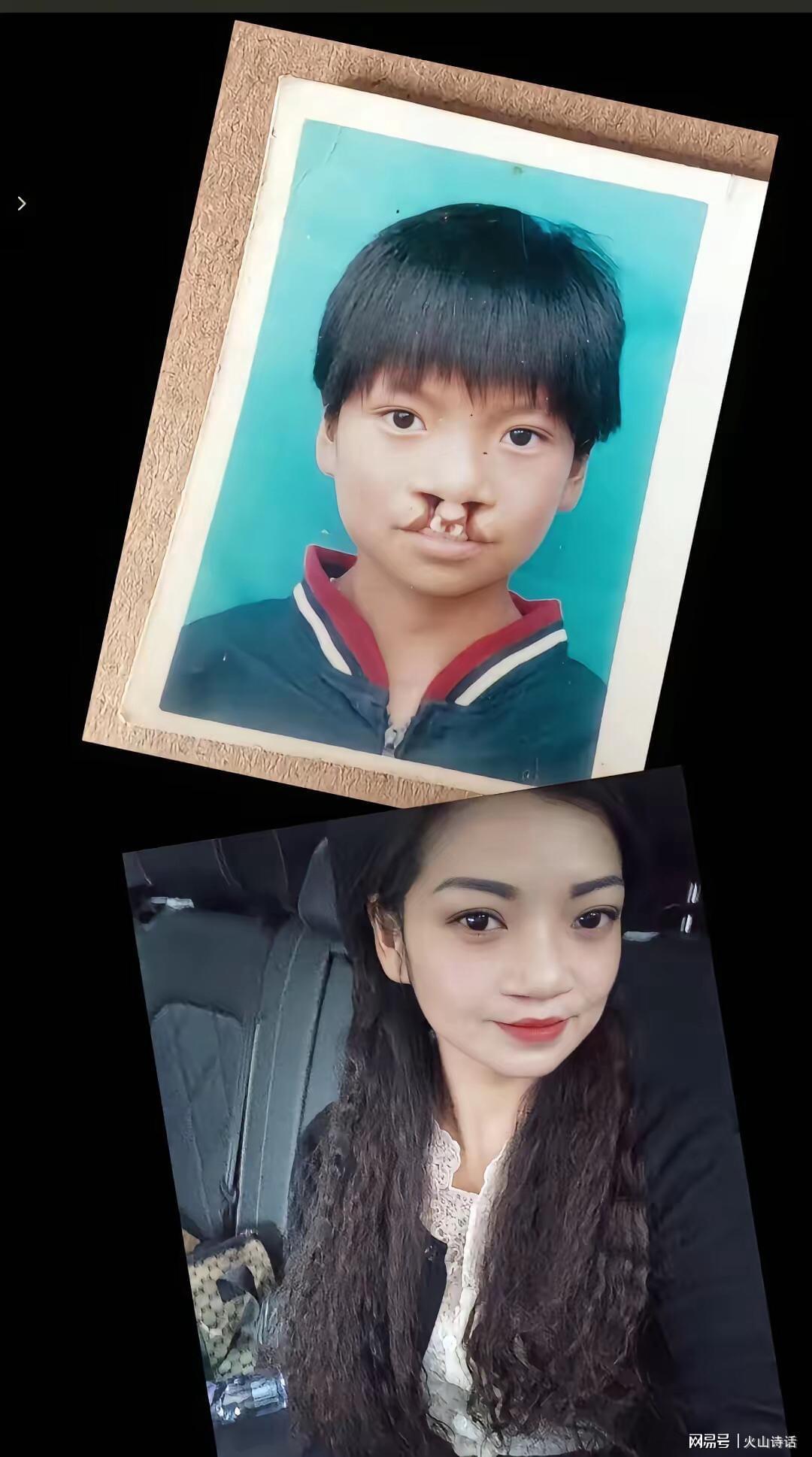 龙8国际app下载-震惊！为声援李亚鹏，一漂亮女孩坦然展示自己唇腭裂手术前后照片